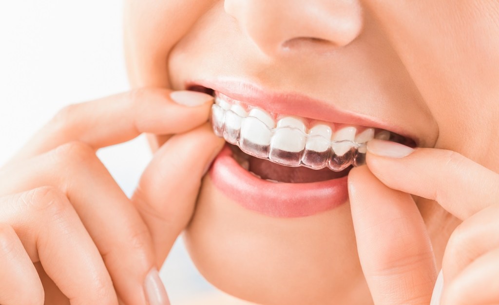 smiling woman placing clear braces into mouth
